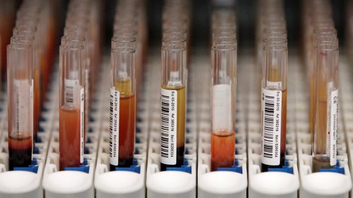 TIDLIGST I MARS: FILE PHOTO: Den omstridte blodprøven som kan avdekke om gravide bærer på et foster med Downs syndrom innføres tidligst til våren neste år.