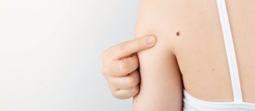 Stadig flere menn over 50 år rammes av føflekkreft.